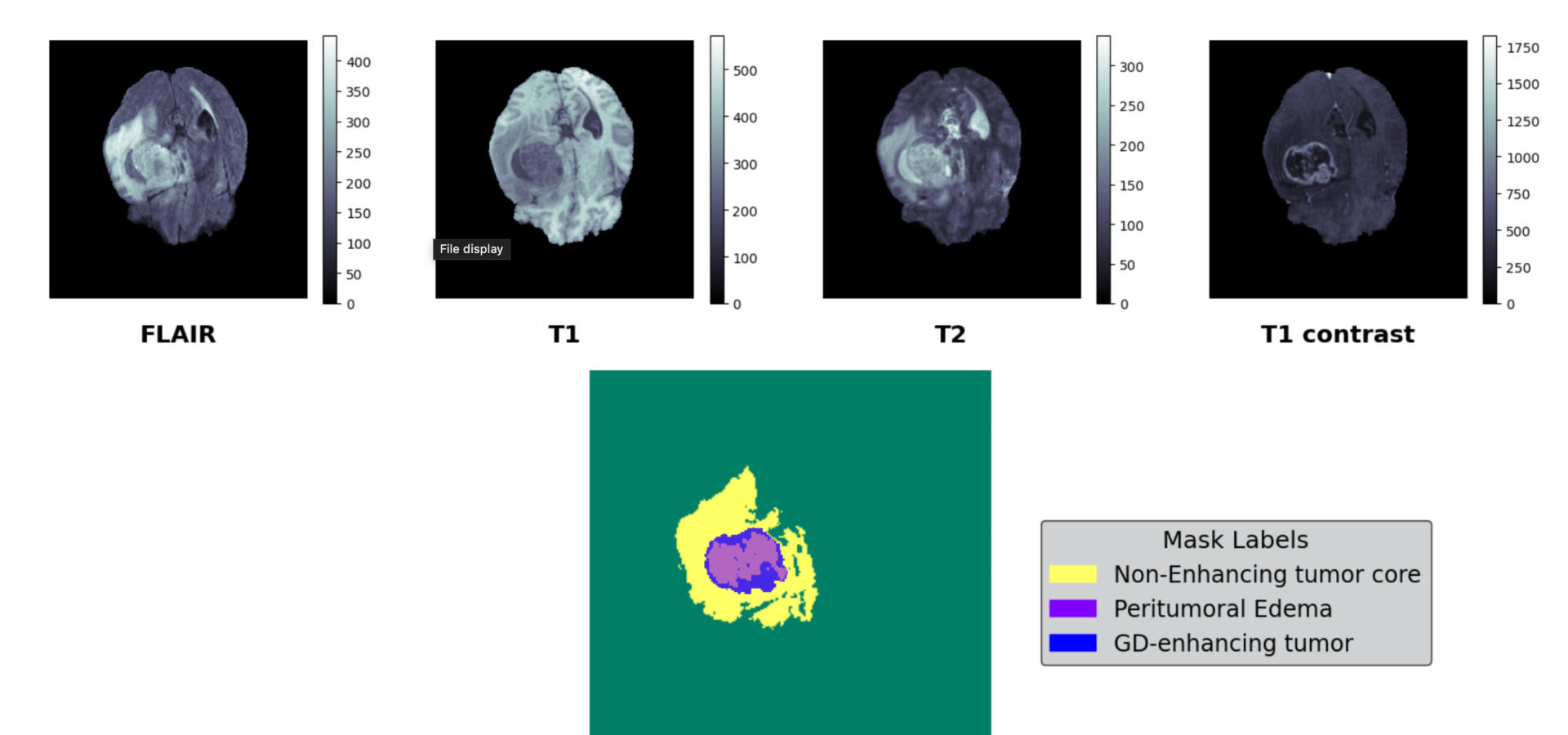 Brain Tumor Segmentation